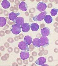 Image:190px-Acute_leukemia-ALL.jpg