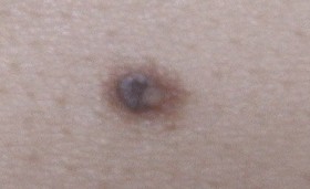 Image:Nevus2.jpg