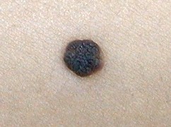 Image:Nevus1.jpg