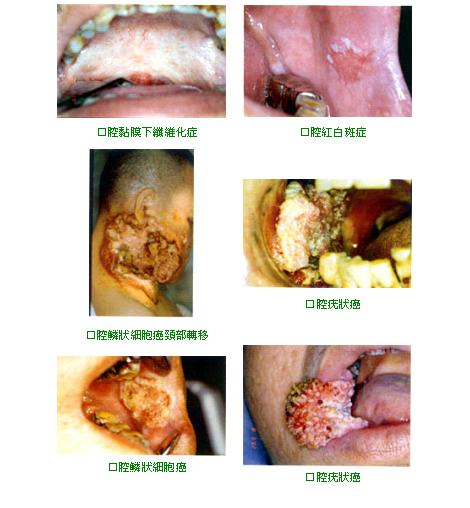 Image:口腔癌.jpg