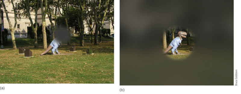 Image:02macular degeneration VS retinitis pigmentosa.png